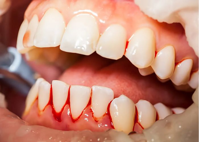 Bleeding Gums