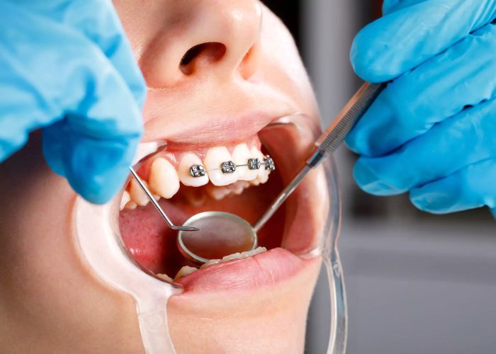 Braces Treatment Damini