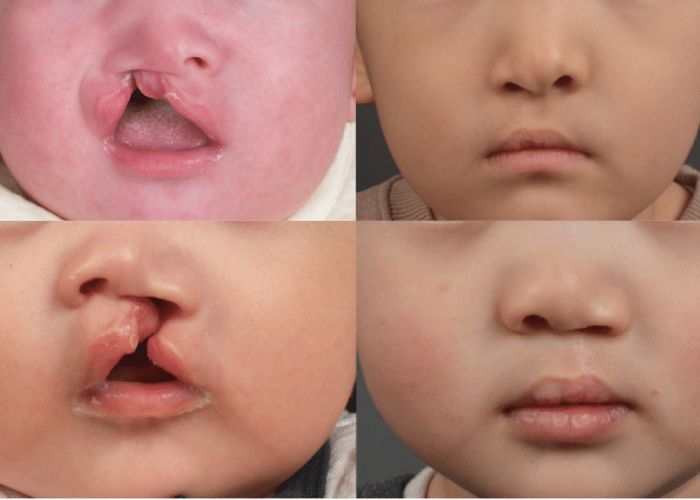 Cleft Orthodontic treatment