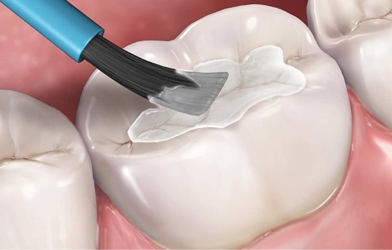Dental Sealants Recovery