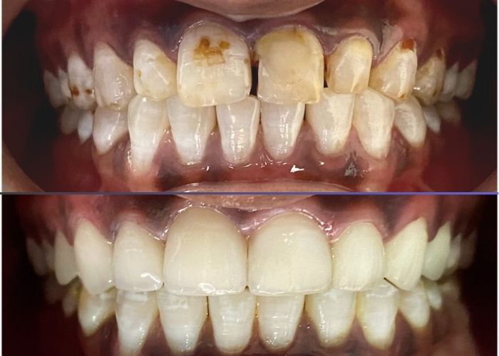 Dental Veneers in Hyderabad