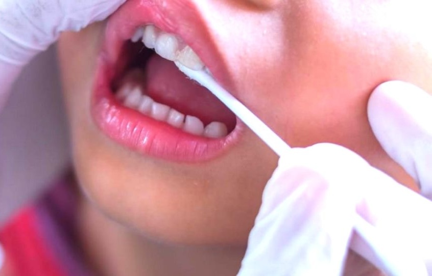 Fluoride Application Treatment in Hyderabad