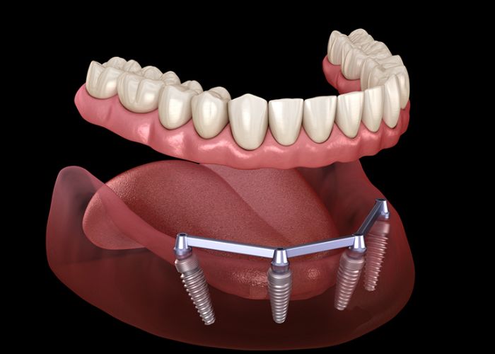 Full Mouth Prosthesis