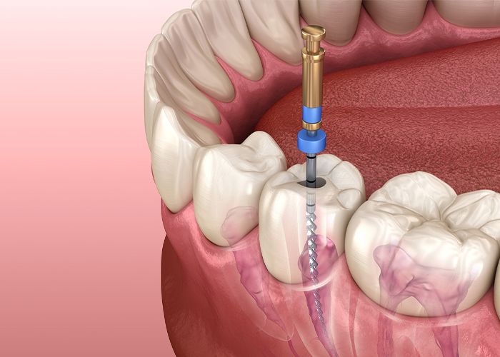 Root Canal
