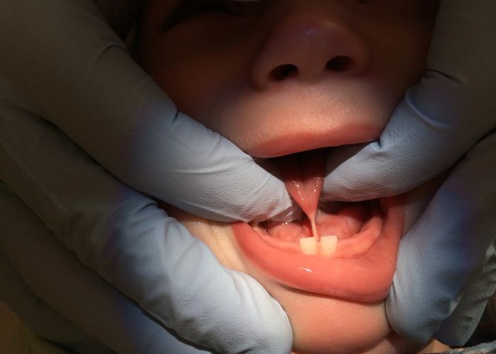 Tongue Tie surgery