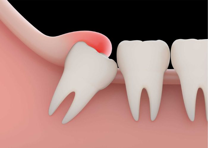 Wisdom Tooth
