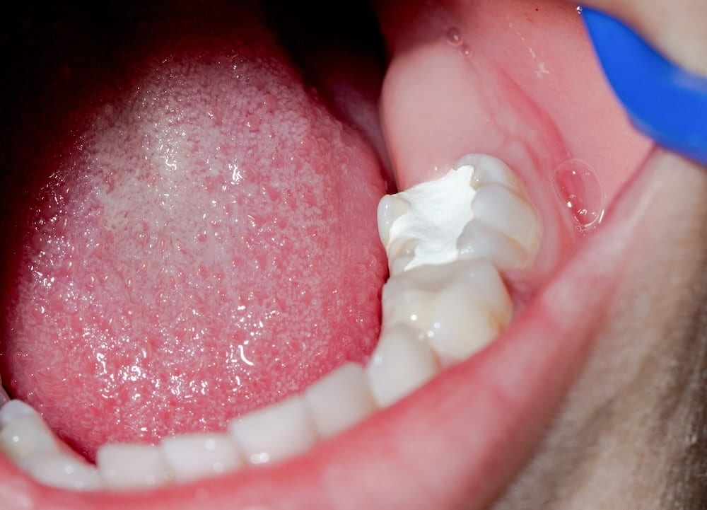 dental-filling-in-hydrabad