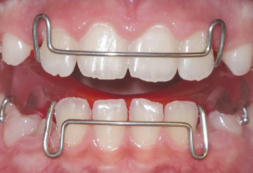 Interceptive Orthodontics