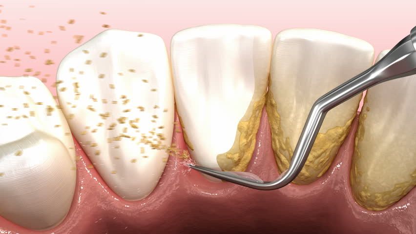 Scaling Polishing Service In Hyderabad